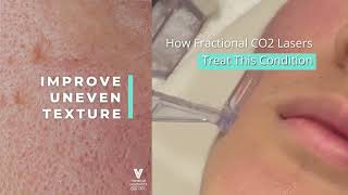 Fractional CO2 Laser Singapore  FAQ  Acne Scars Treatment [upl. by Eiryk]