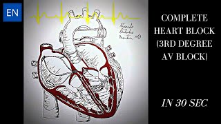 Complete Heart Block 3rd Degree AV Block Animation and ECG Shorts [upl. by Netsrik179]