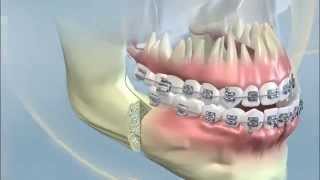 YORK ORTHODONTICS Orthognathic surgery class III [upl. by Ydda]