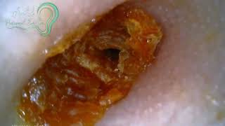 Earwax Removal EP34 [upl. by Amikat]