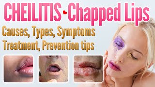 Cheilitis Causes Symptoms Types Risk Factors Treatment Prevention Home remedies  Chapped Lips [upl. by Dibbrun]