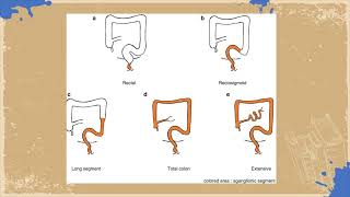 Lecture 4  Hirschsprung disease  Surgical Module SMPediatrics [upl. by Hafinah]