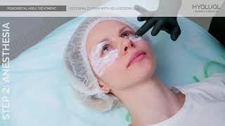 PERIORBITAL AREA TREATMENT Redermalization with Xela rederm 11 [upl. by Riehl336]