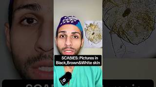 Scabies in Black and Brown Skin Dont Miss These Signs [upl. by Baal221]