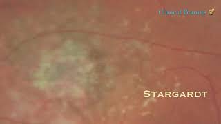 Stargardt Macular Dystrophy [upl. by Adgam]