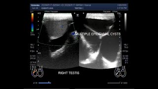 A Large multiseptic Epididymal cyst [upl. by Elden27]