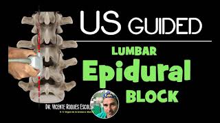 ULTRASOUND GUIDED LUMBAR EPIDURAL INFILTRATION [upl. by Vivyan]