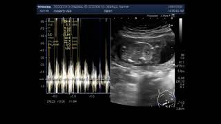 Anencephaly with a pregnancy of about 16 weeks [upl. by Sibylle530]