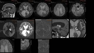 Cavernomatosis cerebral [upl. by Jolie285]