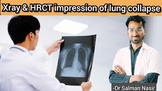 Chest Xray vs HRCT Findings Explained  Common Respiratory Conditions Diagnosis [upl. by Santini976]