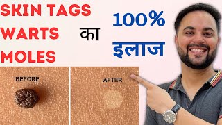 Skin Tags Warts amp Moles का 100 इलाज with Home Remedies [upl. by Sheply326]