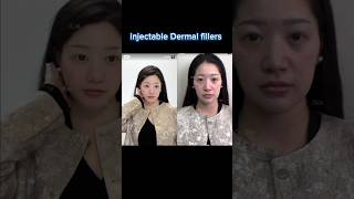 injectable Dermal fillers beautytransformed facetransformation [upl. by Amby]