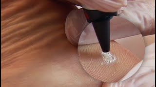 Plantar Wart Treatment [upl. by Sivet]