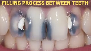 Front teeth filling process  composite filling  cavity filling  teeth damage repair [upl. by Enaile951]