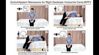 GufoniAppiani Manoeuvre for Right Geotropic Horizontal Canal BPPV [upl. by Ardnat]