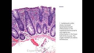 Lymphocytic colitis [upl. by Grieve]