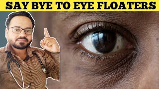 How to get rid of Eye Floaters Naturally [upl. by Neslund]