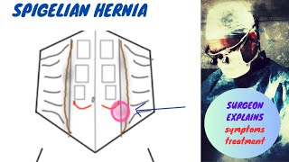 Spigelian Hernia [upl. by Yevette430]