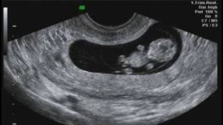 Compilation 9 weeks 2 days Ultrasound [upl. by Shanahan512]