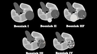 Bosniak Classification for Renal Cystic Disease [upl. by Anitnuahs]