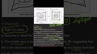 Hess Chart  Superior Oblique Palsy [upl. by Tarfe486]