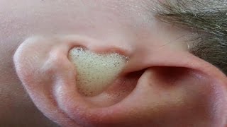 Natural Home Remedies for Ear Infection [upl. by Filberte]