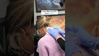 Removing All Of My Tattoos Tattoo Removal Before and After 🤍 tattooremoval [upl. by Billen487]