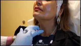 Neck Platysmal Band Treatment with Botox [upl. by Sugden]