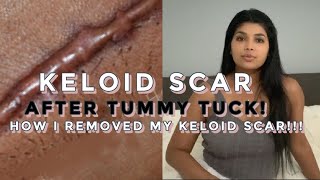 MY TUMMY TUCK KELOID SCAR amp How I had it removed [upl. by Rikki]