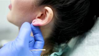 Earlobe Repair  Clinique Dallas Plastic Surgery [upl. by Kristian]