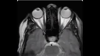 Eye movement during MRI [upl. by Nuahsed]