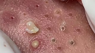 Nasa SPA 03 satisfying cyst relaxing blackhead pimple acne [upl. by Einnos]