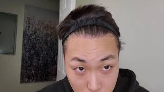 HAIRLICIOUSLY DAY 84 FUE HAIR TRANSPLANT RESULTS [upl. by Neeron]