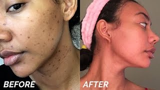 HOW TO GET RID OF DARK SPOTS amp HYPERPIGMENTATION FAST [upl. by Strander180]