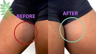 Clear Inner Thighs Fast  DIY [upl. by Susumu]