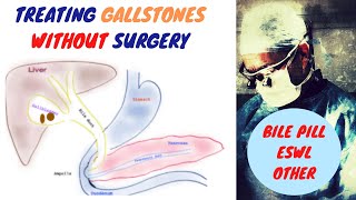 Treating Gallstones WITHOUT Surgery [upl. by Eiba]