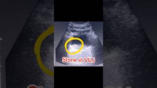 Ureteric Stone  VUJ Stone  Bladder Stone on Ultrasound [upl. by Dur]