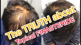 Topical Finasteride  Minoxidil results after 6 Months [upl. by Boaten154]