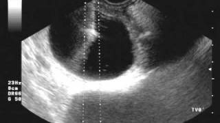 ovarian cyst drainage [upl. by Theodoric]