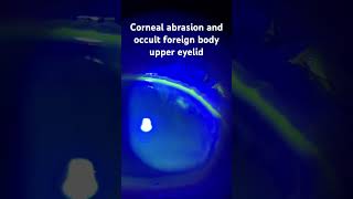 Corneal abrasion and occult foreign body under the upper eyelid protectingsight ophthalmology [upl. by Fitalludba]