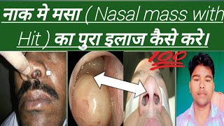 Nasal Polyps नाक मे मसा  Nasal mass with Hit  का पुरा इलाज कैसे करे। Abhia2zmedical [upl. by Boleyn]