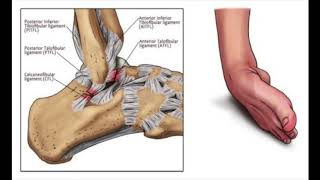 Lateral Ankle Sprains Anatomy Overview [upl. by Atteynad]