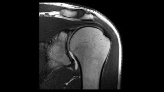 PROTOCOLO RESONANCIA MAGNETICA DE HOMBRO [upl. by Helge432]