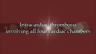 Intracardiac Thrombosis Involving All Four Cardiac Chambers [upl. by Reahard]