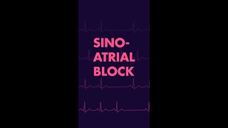 Sinus Block  Cardiac Rhythm EKG [upl. by Etteniuqna563]