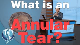 What Is An Annular Tear [upl. by Jacquelynn]