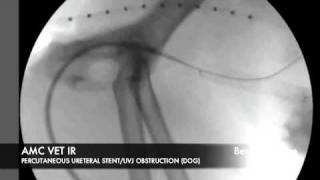 Interventional Radiology Percutaneous Ureteral Stent [upl. by Eniretac82]