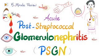 Acute PostStreptococcal Glomerulonephritis APSGN Nephritic Syndrome Kidney PathologyNephrology [upl. by Aramad753]