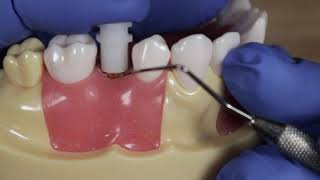 Closed Tray Impression Coping  How to Take A Closed Tray Impression [upl. by Nahsin]