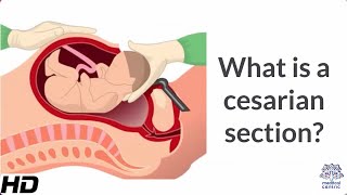 What is a Cesarian Section [upl. by Ahab]